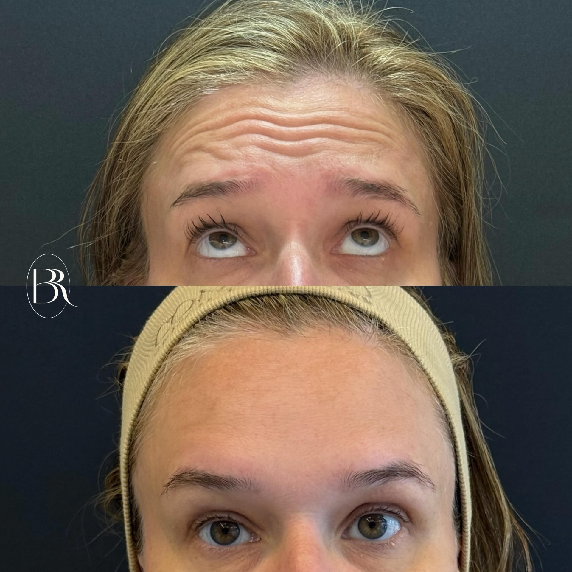 Antes e depois — Toxina botulínica: Suavização das linhas da testa