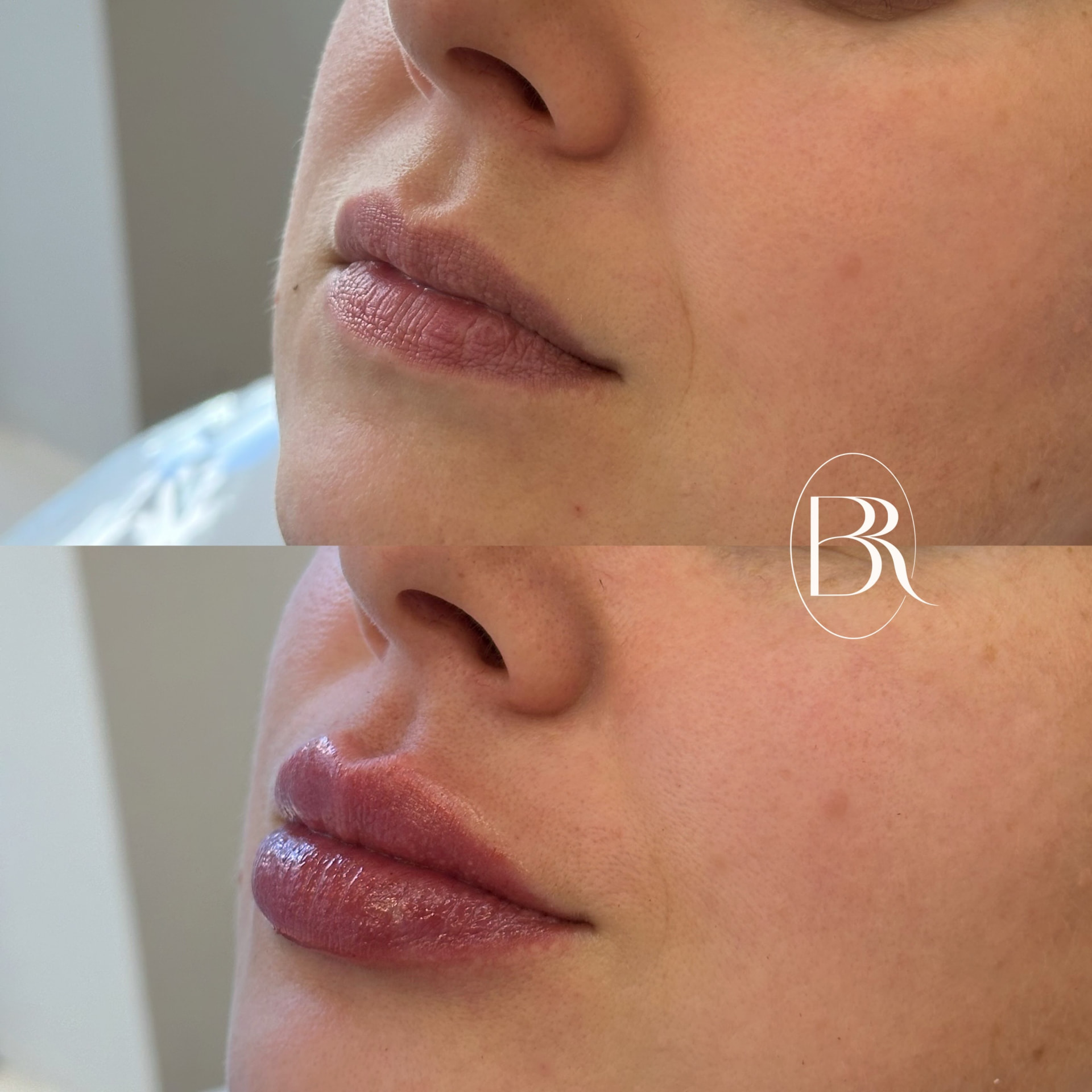 Antes e depois — Preenchimento labial: Contorno e volume em perfil