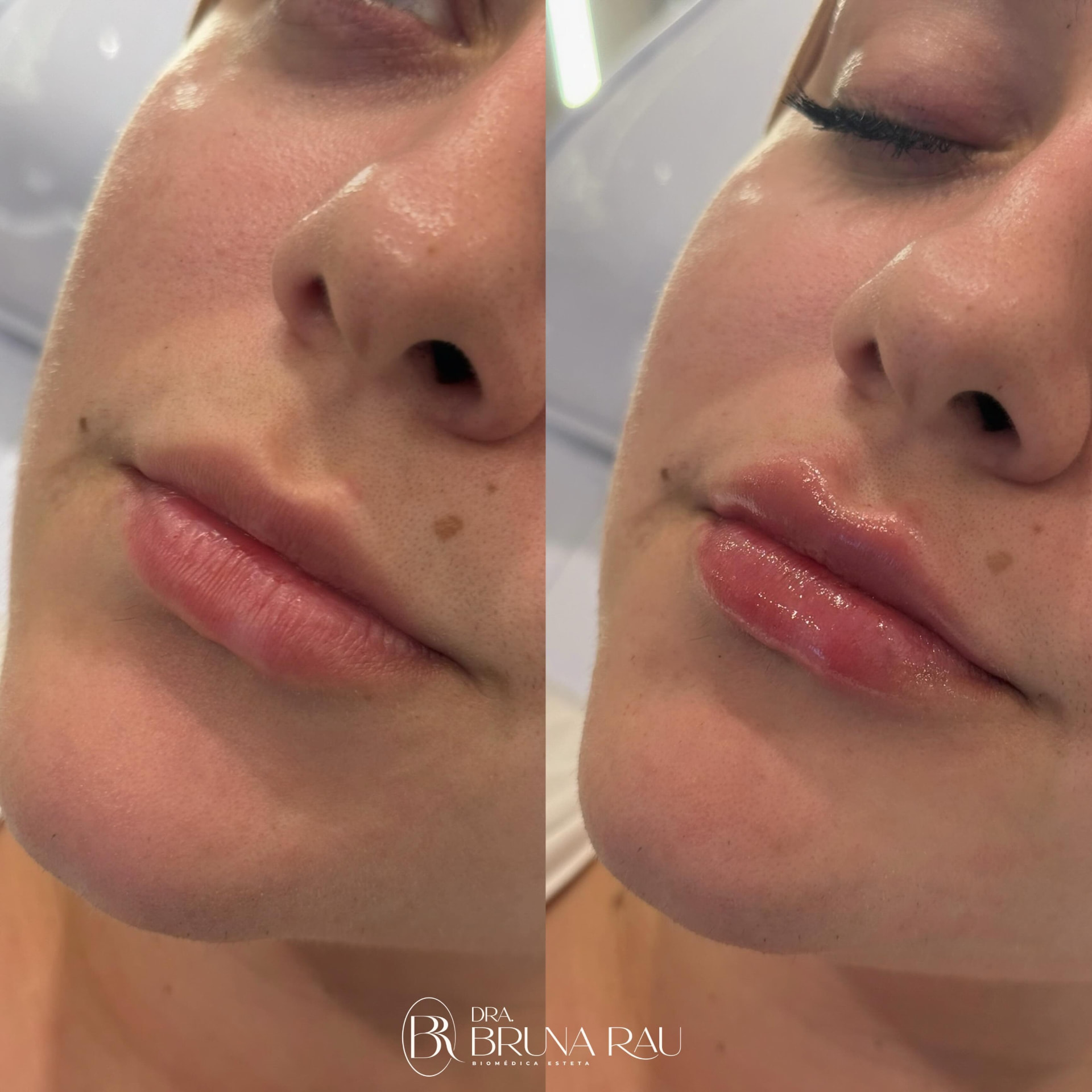 Antes e depois — Preenchimento labial: Hidratação e definição dos lábios