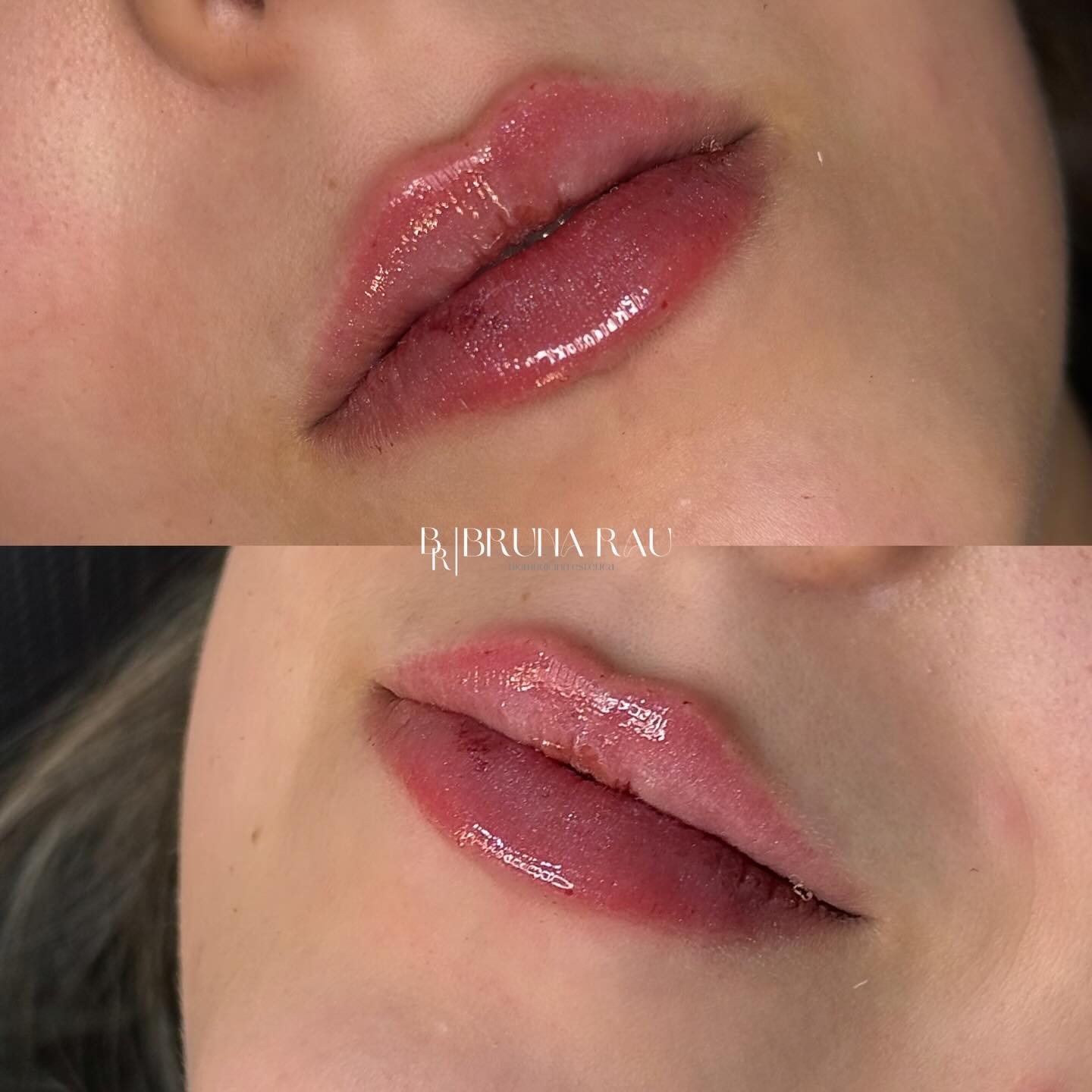 Antes e depois — Preenchimento labial: Volume equilibrado e natural