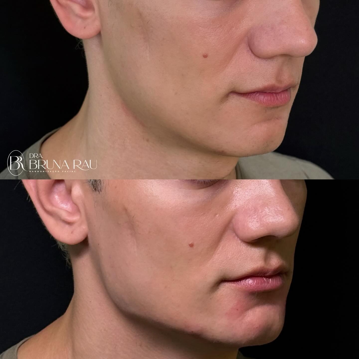 Antes e depois — Harmonização facial: Definição de mandíbula e contorno